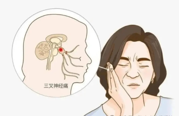 刷牙也成酷刑？何先生十天面痛难题，微创技术迎刃而解